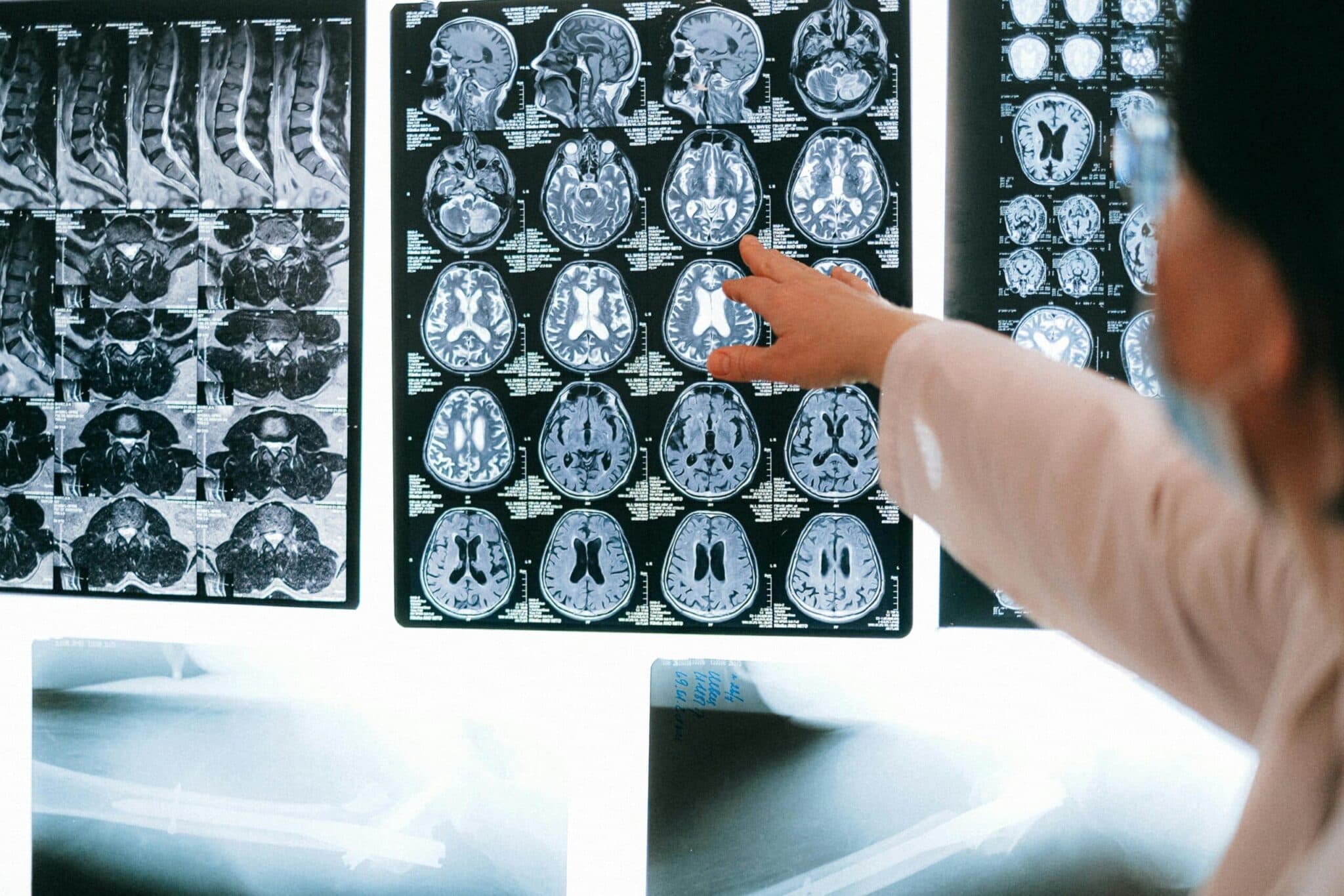 Lesiones cerebrales traumáticas: Entender los efectos a largo plazo