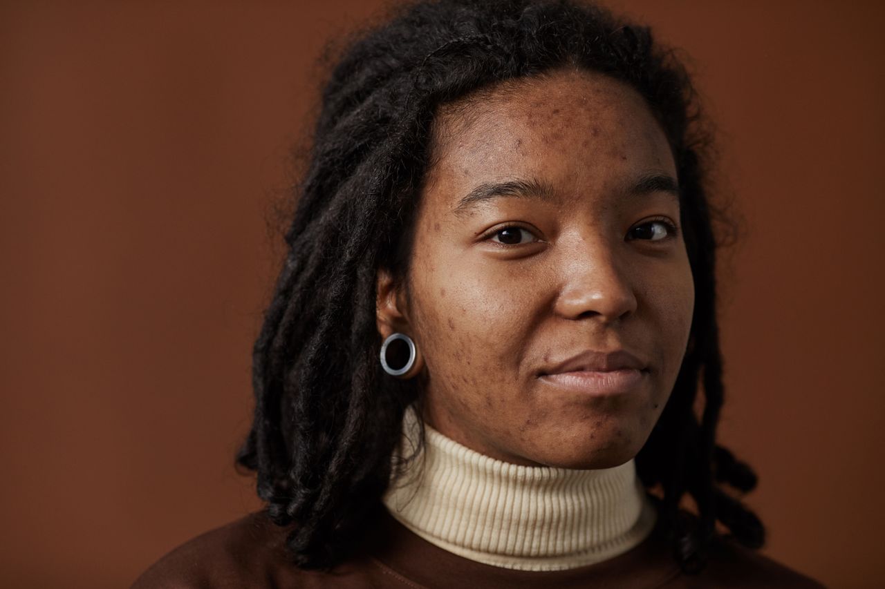 What Adult Acne Actually Does to Your Mental Health