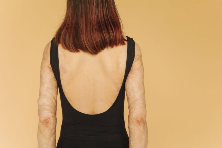 What Nobody Tells Burn Survivors About Healing Psychologically